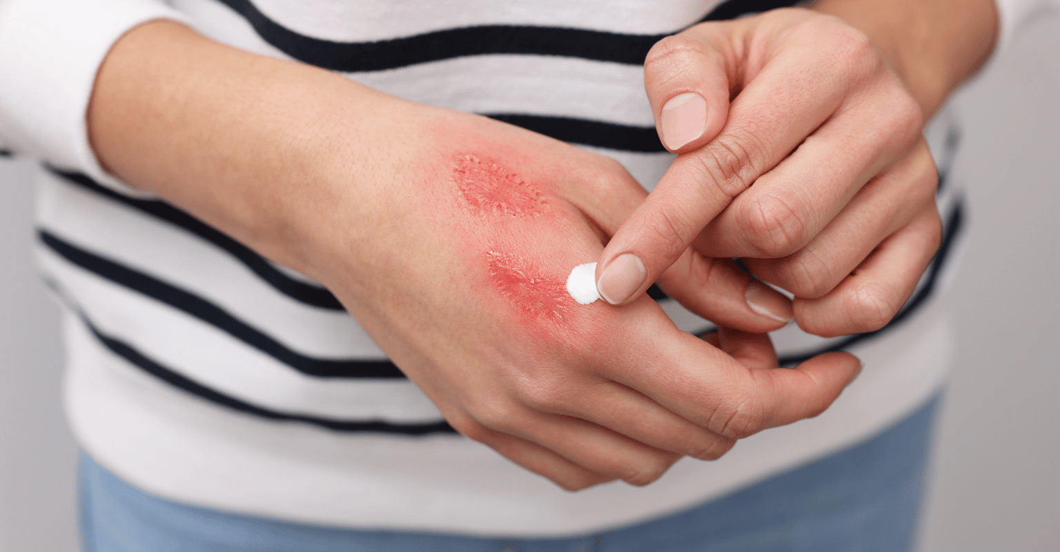 Burn Injuries