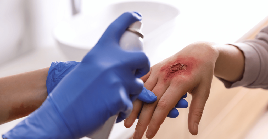burn injury (3) Burn Injuries