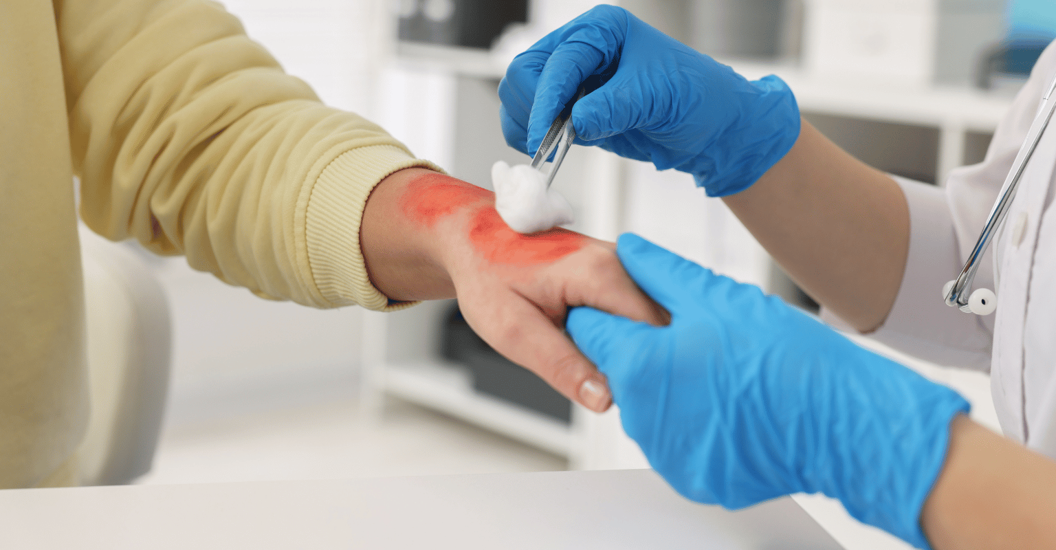 Burn Injuries