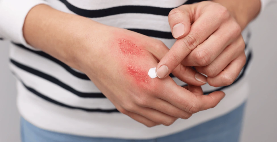 Burn Injuries