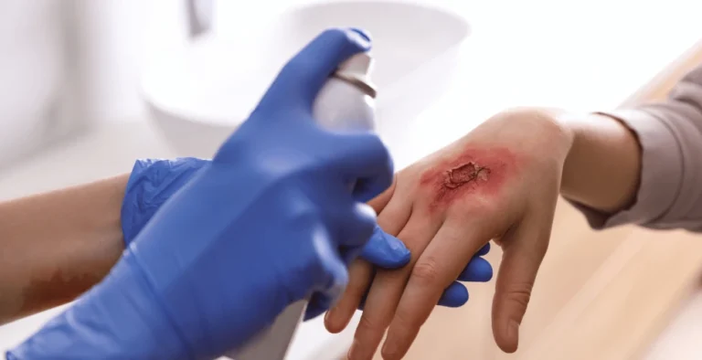 Legal Assistance for Victims of Fire and Chemical Burns