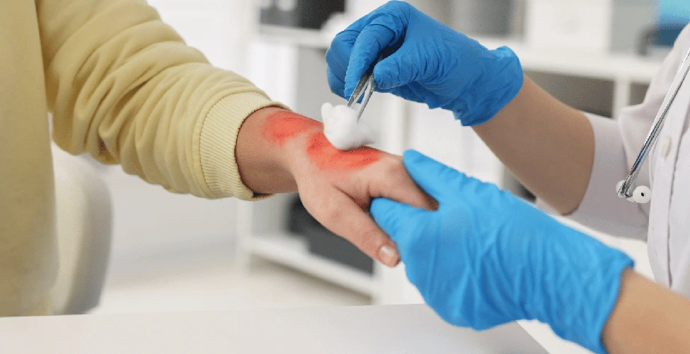 Burn Injuries