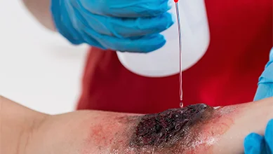 Burn Injury