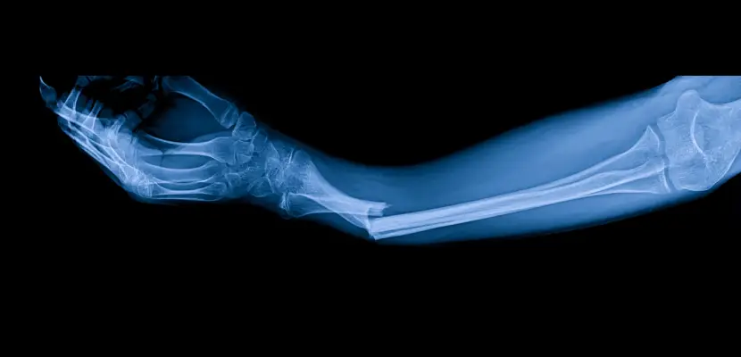 broken-bone-img
