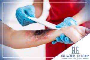 Burn Injury Attorneys