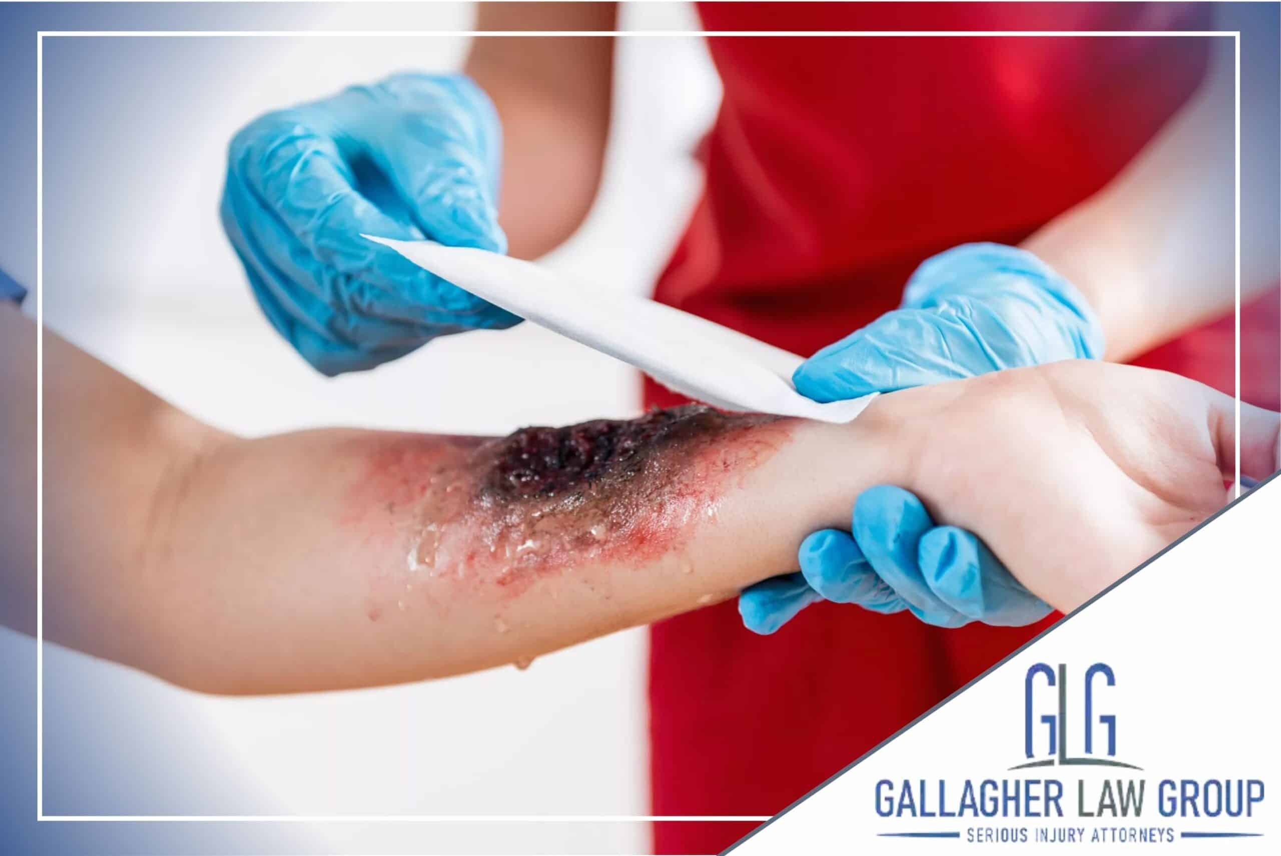 Burn injury attorneys