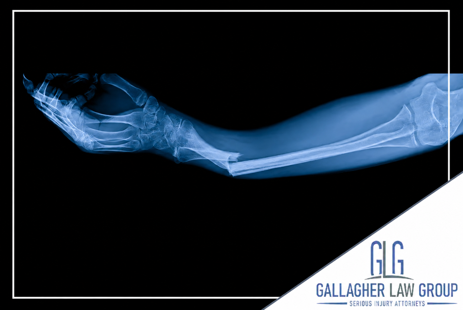 Phoenix Broken Bone and Fracture Injury Lawyer